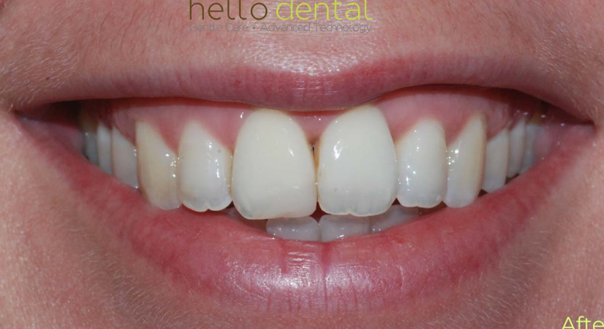 After - Hello Dental